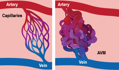 Diagram showing normal blood vessel flow and AVM tangle